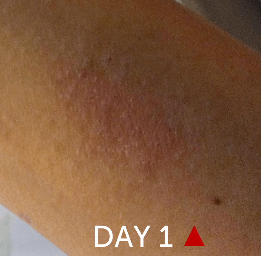 Itch Redness Infection Rash Gone In 5 Days Stories Of Grace