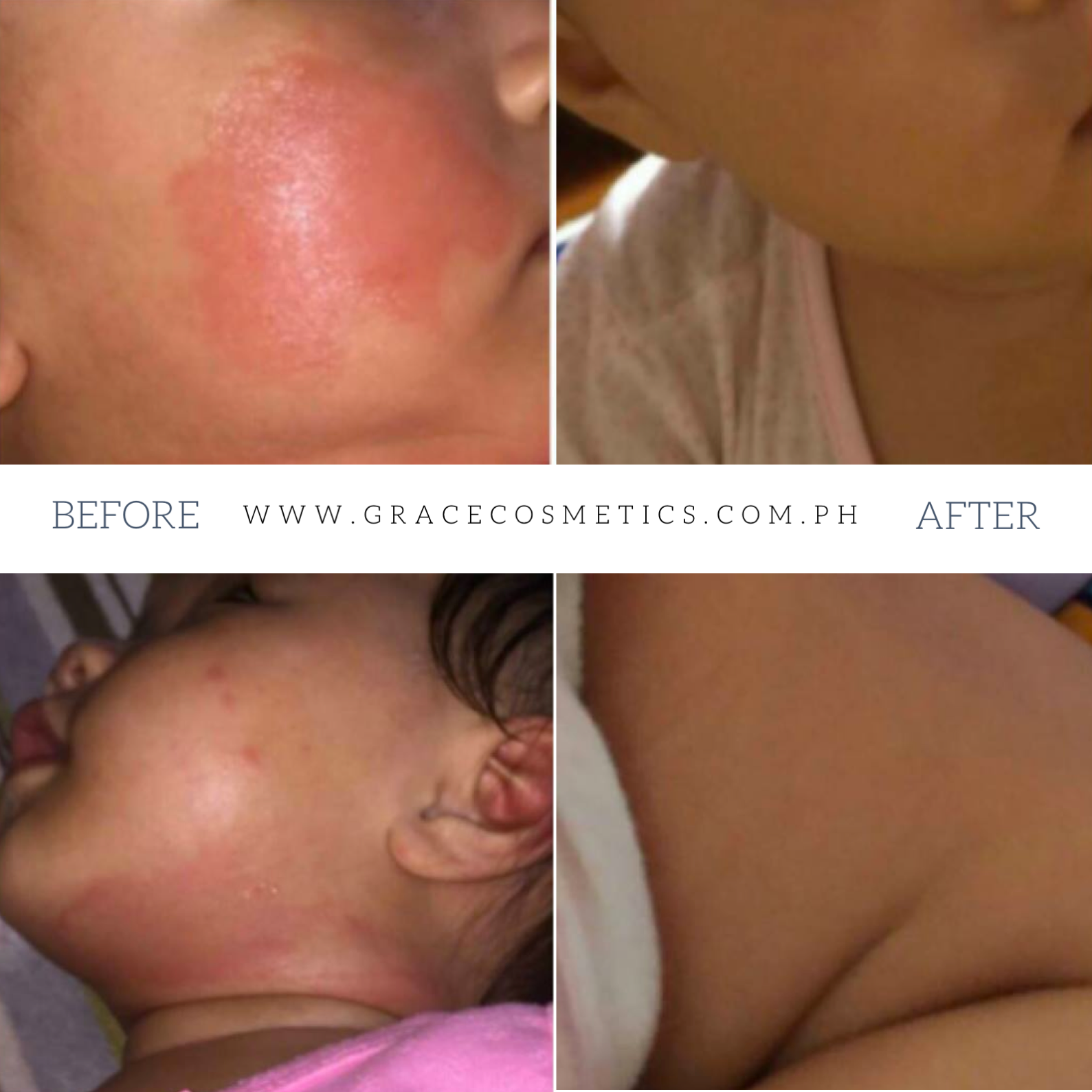 Infant rash and irritation gone in 1 day with the Aloe Medicated Skin Cream